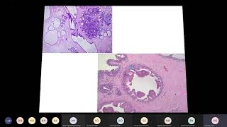 benign proliferative breast lesions [upl. by Nagaer]