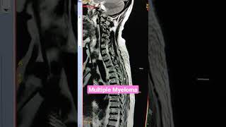 Multiple Myeloma Spine MRI viral mri youtubeshorts [upl. by Odragde]