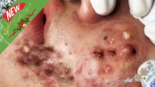 Blackheads amp Acne Treatment Hottest Videos 128 [upl. by Nyrrad]