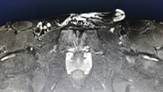 Osteitis pubis  MRI findings [upl. by Necyla]