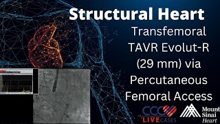 SAPIEN 3 TAVR 26mm via Percutaneous Femoral Access  Structural Live Jan 2017 [upl. by Brent844]