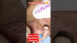 NEXT LEVEL BLACKHEAD REMOVAL  It Just Kept Coming shorts [upl. by Nnahtebazile]