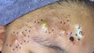 Big Cystic Acne Blackheads Extraction Blackheads amp Milia Whiteheads Removal Pimple Popping  1969 [upl. by Adnwahsat]