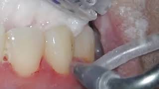 Airflow Teeth Polishing [upl. by Burchett449]