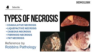 Necrosis  Types of Necrosis  Coagulative  Liquefactive  caseous  Fat  Fibrinoid  KTC MBBS [upl. by Dwane892]