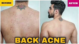 How To Get Rid of Back Acne Fast [upl. by Notse]