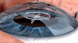 Watch live surgery using the laser cataract system  how does it work Eye News TV [upl. by Sharron]