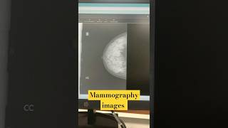 mammography images radiologycareer doctor radiologytechnologist viralshort radiographer viral [upl. by Ramin312]