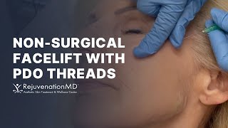 PDO Threads Your Key to a NonSurgical Facelift [upl. by Lind]