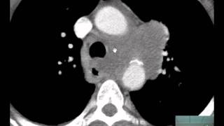 56yoM CXR CT Chest Adenopathy Discussed by Radiologistmp4 [upl. by Welles]