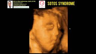 Sotos Syndrome [upl. by Jeni]