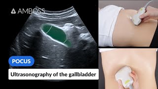 Point of Care Ultrasound of the Gallbladder  AMBOSS Video [upl. by Yelrebma805]