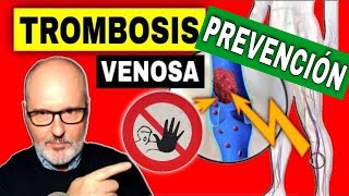 10 PASOS para EVITAR la TROMBOSIS VENOSA PROFUNDA en piernas [upl. by Roslyn]