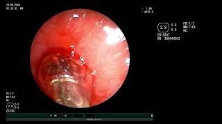 Emergent Central airway obstruction Subglottic stenosis  Dilatation and silicone stent placement [upl. by Annayk584]