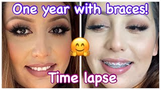 ONE YEAR WITH BRACES  Time Lapse  Correcting OverjetOverbite  Damon Braces [upl. by Aynotahs]