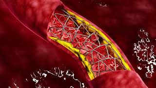 Carotid Artery Disease CAD [upl. by Vilberg441]