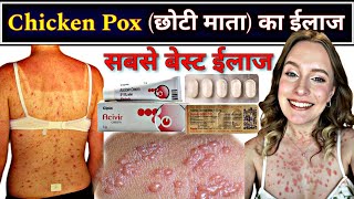 चिकन पॉक्स का बेस्ट ईलाज  Chicken pox treatment  छोटी माता का ईलाज  चेचक का ईलाज chickenpox [upl. by Burnard]