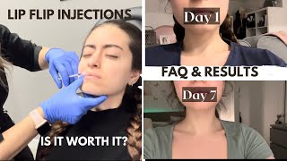 Lip flip botox injection  day by day comparison  FAQ amp results  everything you need to know [upl. by Eeuqram]