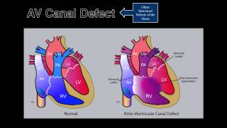 Fetal Echocardiography AV Canal Defect [upl. by Eissej136]