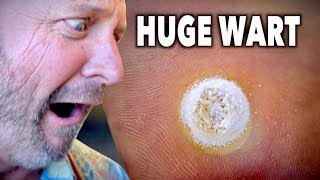 HUGE DECAYING WART Frozen With Liquid Nitrogen  Dr Paul [upl. by Arakawa988]