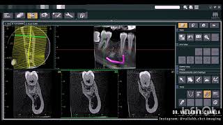 CONDENSING OSTEITIS  OPG vs CBCT 2D vs 3D IMAGING MODALITY [upl. by Warfield27]