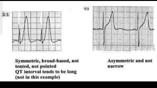 Hyperacute T waves of ischaemia on ECG [upl. by Aimik]