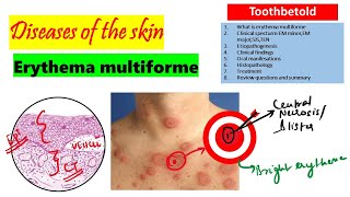 Erythema Multiforme  Etiology Clinical features Histopathology treatment [upl. by Otrebla193]