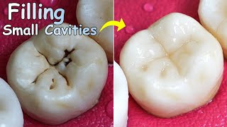 The Amazing Way of Doing Tooth Restoration  Repairing Pit and Fissure Caries [upl. by Edurtreg803]