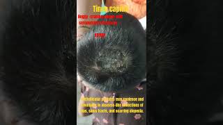 Tinea capitis kerion awarenesshaircarefungalinfectionsdrvaraprasadtineaalopecia childhood [upl. by Ivgnout]