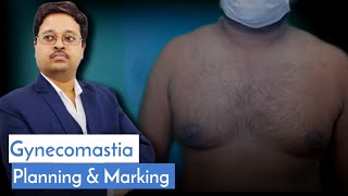 Gynecomastia Planning amp Marking  Dr Jayanta Bain Plastic surgeon  Kolkata [upl. by Tager253]