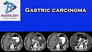 Gastric carcinoma [upl. by Artenal306]