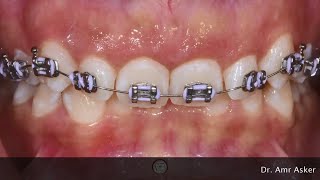 Braces timelapse  Deep Bite progress [upl. by Ennayhs]