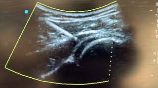 Ultrasound guided Hydrodilatation of the shoulder joint [upl. by Alarick]