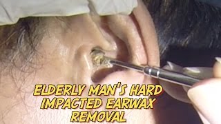 Elderly Mans Hard Impacted Earwax Removal [upl. by Arutnev661]