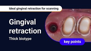 Thick biotype  Ideal gingival retraction for scanning [upl. by Zetrac747]