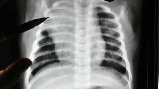 Right upper lobe lung collapse on chest x ray [upl. by Gennie]