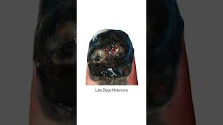 Fingernail Melanoma Development Time Lapse or Toenail [upl. by Narba5]