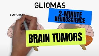 2Minute Neuroscience Brain tumors [upl. by Harlen]