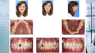 How To Get An Unbiased Second Opinion On Your Orthodontic Treatment [upl. by Austreng]