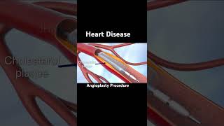 Heart coronary artery disease [upl. by Ahsek427]