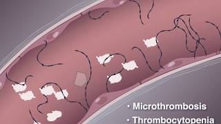 Improving Outcomes in TTP [upl. by Enenej]