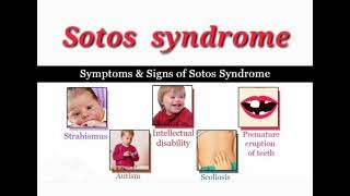 Sotos syndrome mrcpch Clinical General Examination [upl. by Iinde]