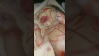 Newborn Baby looks abnormal due to rare skin condition shorts different [upl. by Felicio]