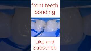 Dental bonding front teeth asmr localdentistry satisfying youtubeshorts ytshortsindia [upl. by Redliw702]