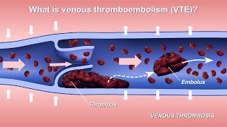 Understanding and Diagnosing Venous Thromboembolism VTE [upl. by Suiraj511]