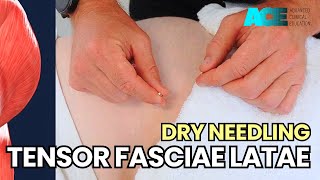 Dry Needling Tensor Fasciae Latae [upl. by Atteoj]