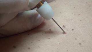 Hyperkeratosis removal with Plexr [upl. by Esekram]