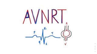 Atrioventricular Nodal Reentrant Tachycardia AVNRT SVT ecgtutorial cardiology AVRT Arrhythmia [upl. by Nrubliw131]