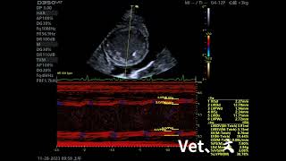 Dilated Cardiomyopathy DCM [upl. by Adialeda]