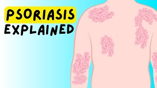 What is Psoriasis Definition Etiology Classification Pathophysiology Diagnosis Treatment [upl. by Nnylatsirk]